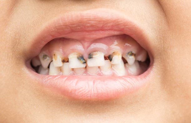 تسوس الاسنان اللبنية الامامية
