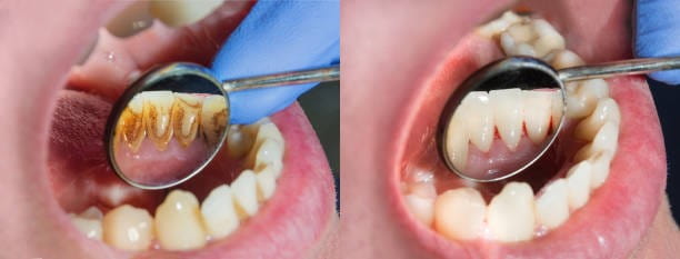 الوقاية من اصفرار الاسنان
