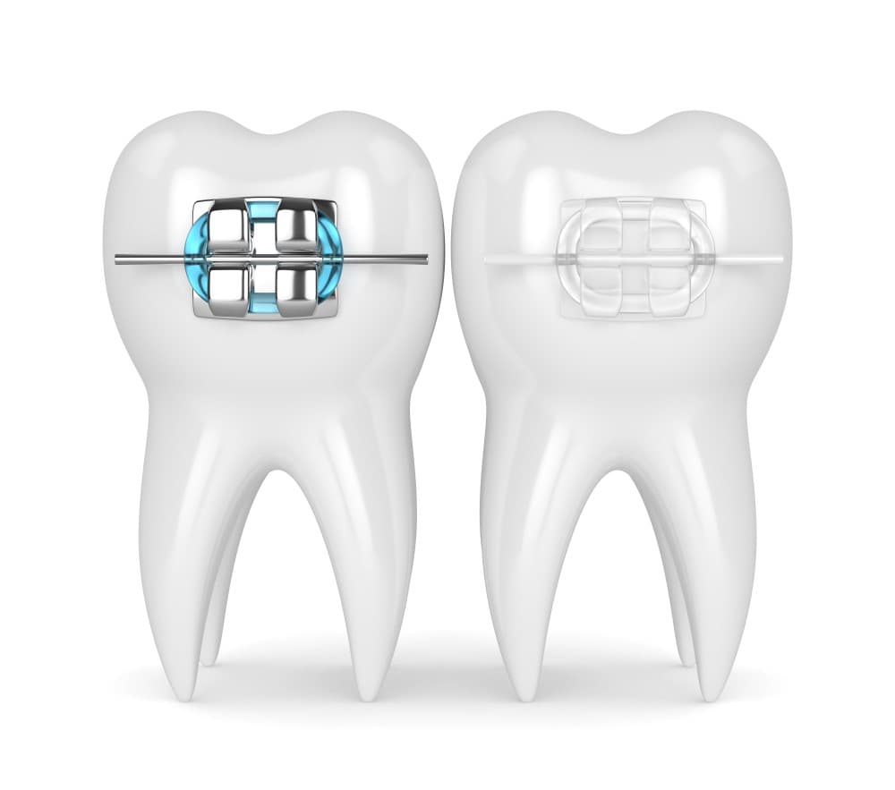 clear braces vs metal
