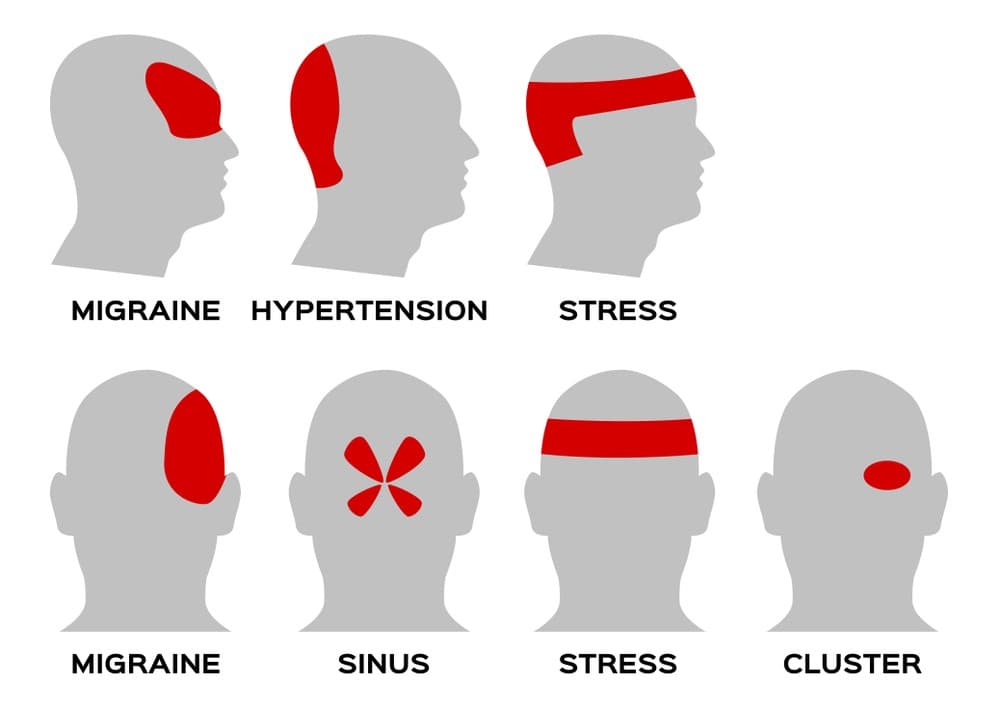 Headache Chart Types By Symptoms Location And Causes - vrogue.co