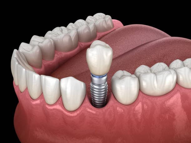تثبيت الاسنان في مواقع ضحلة