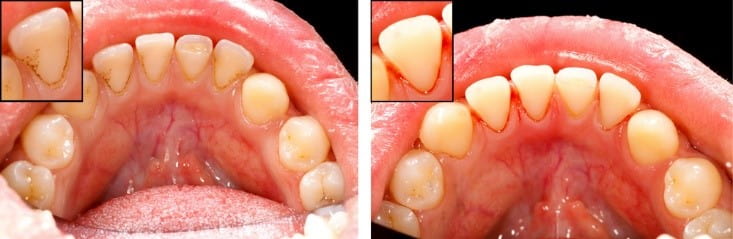 Gingivitis before and after