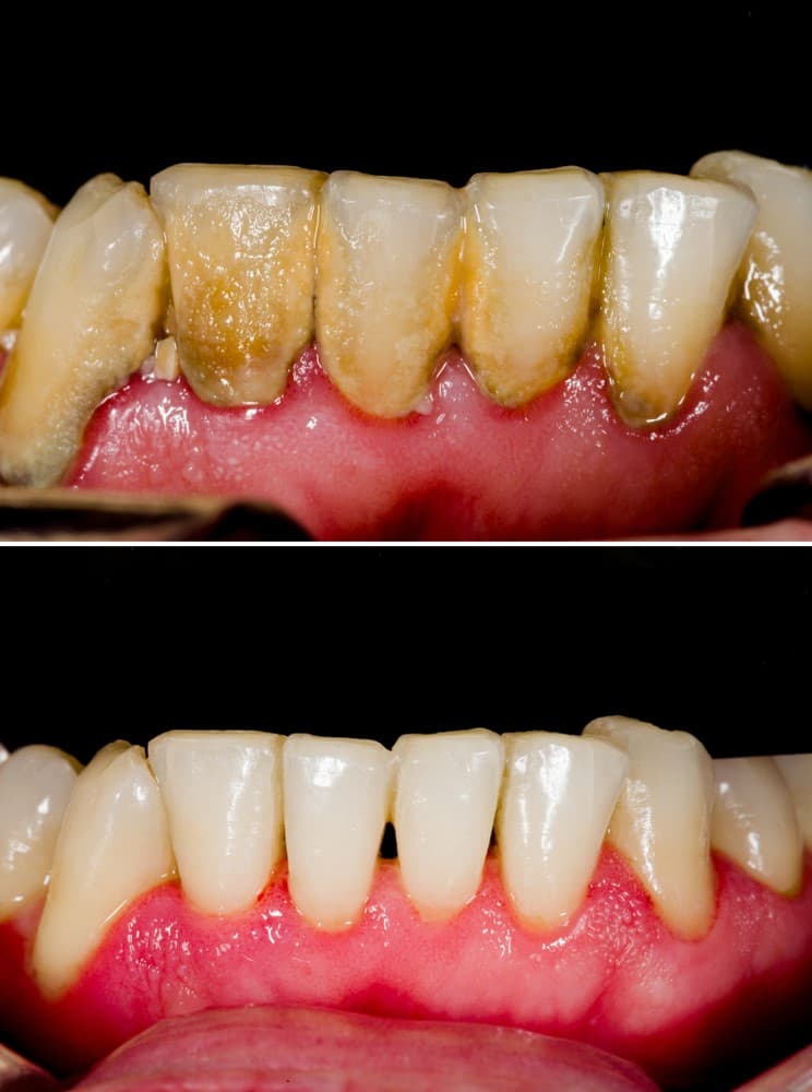 Gingivitis before and after 1