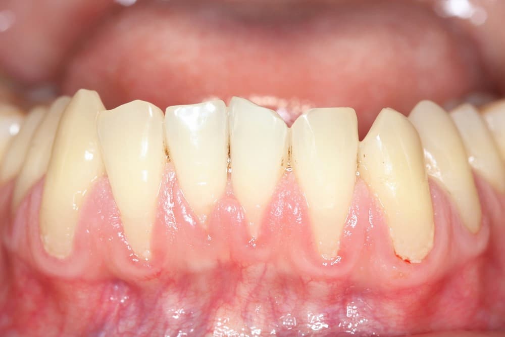 Shrinking gums and gum diseases