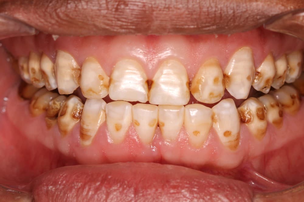 Top 20+ how to get rid of yellow teeth 1 Yellow teeth: what is it and how to get rid of it?