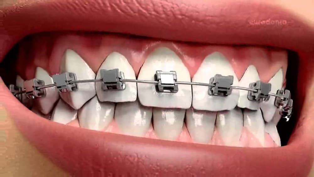 appareil dentaire auto-ligaturant
