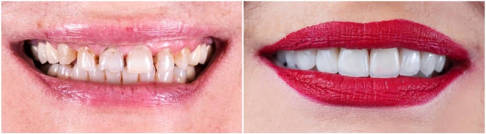 Cosmetic dentistry before and after 02