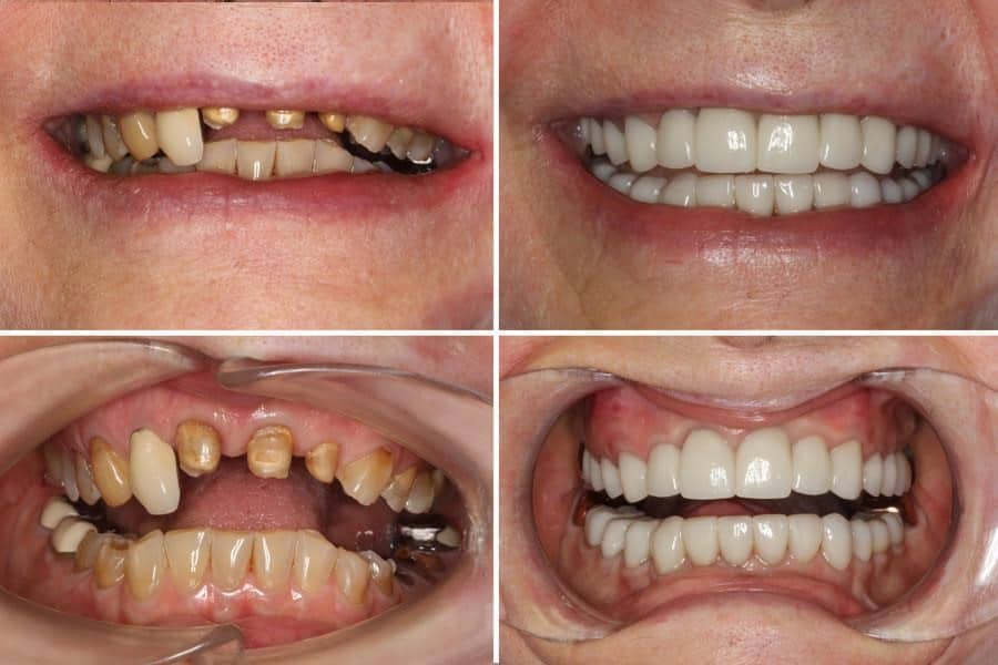 Cosmetic dentistry before and after 04