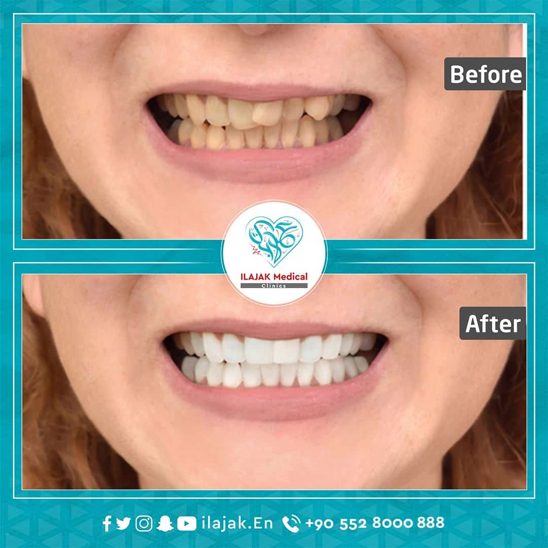Hollywood Smile in Turkey before and after 1