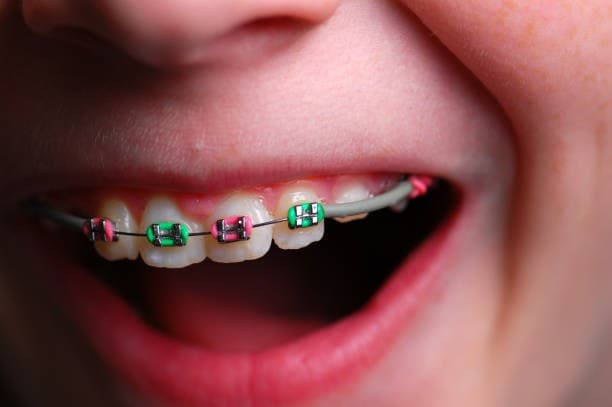 ألوان تقويم الأسنان للبنات
