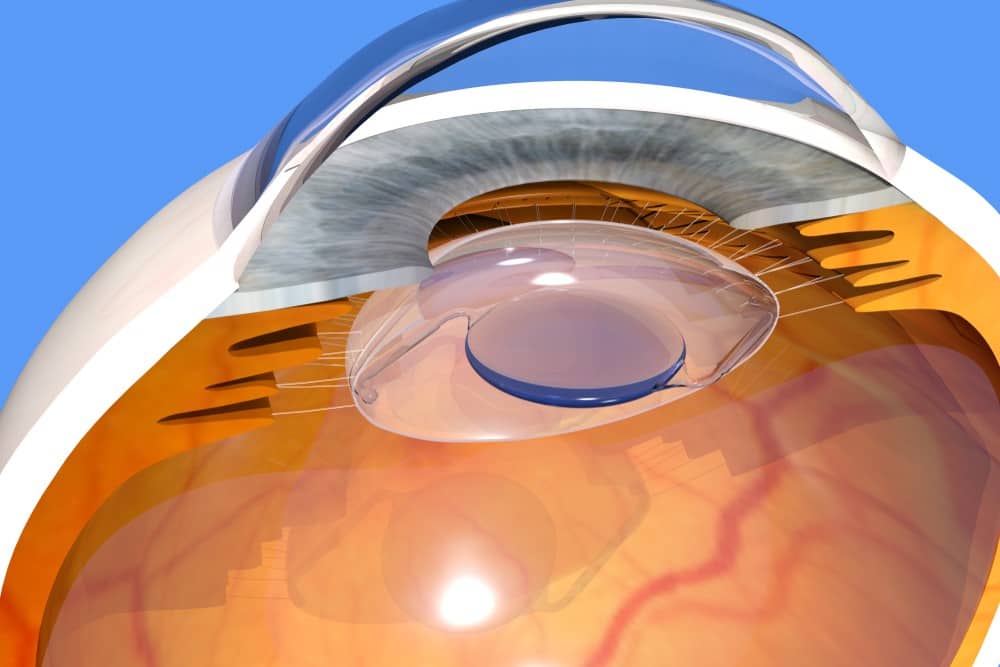 Types de chirurgie de la cataracte