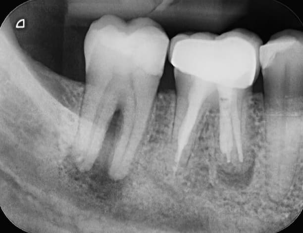 Tooth abscess Xray