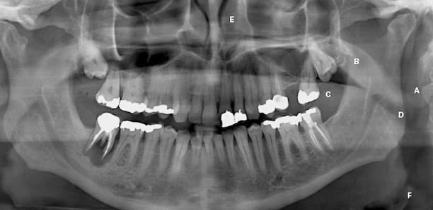 Tooth abscess Xray 1