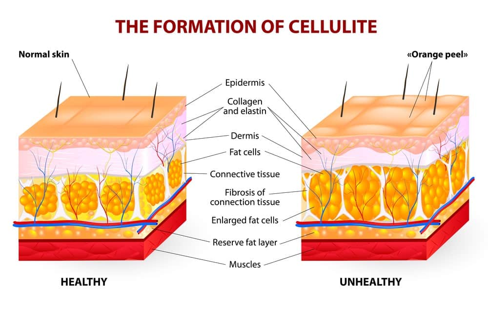Types of cellulite pictures