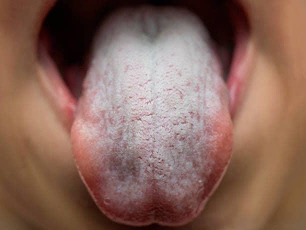 أعراض جفاف الفم