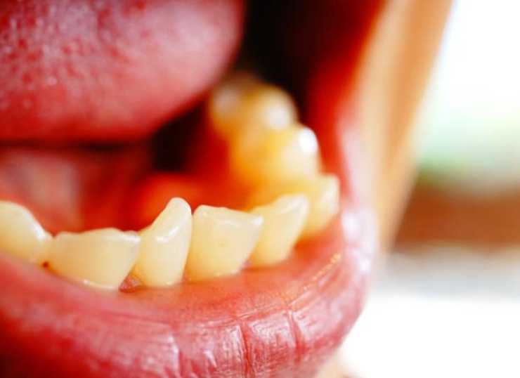 اعوجاج الاسنان - اعوجاج الاسنان السفلية