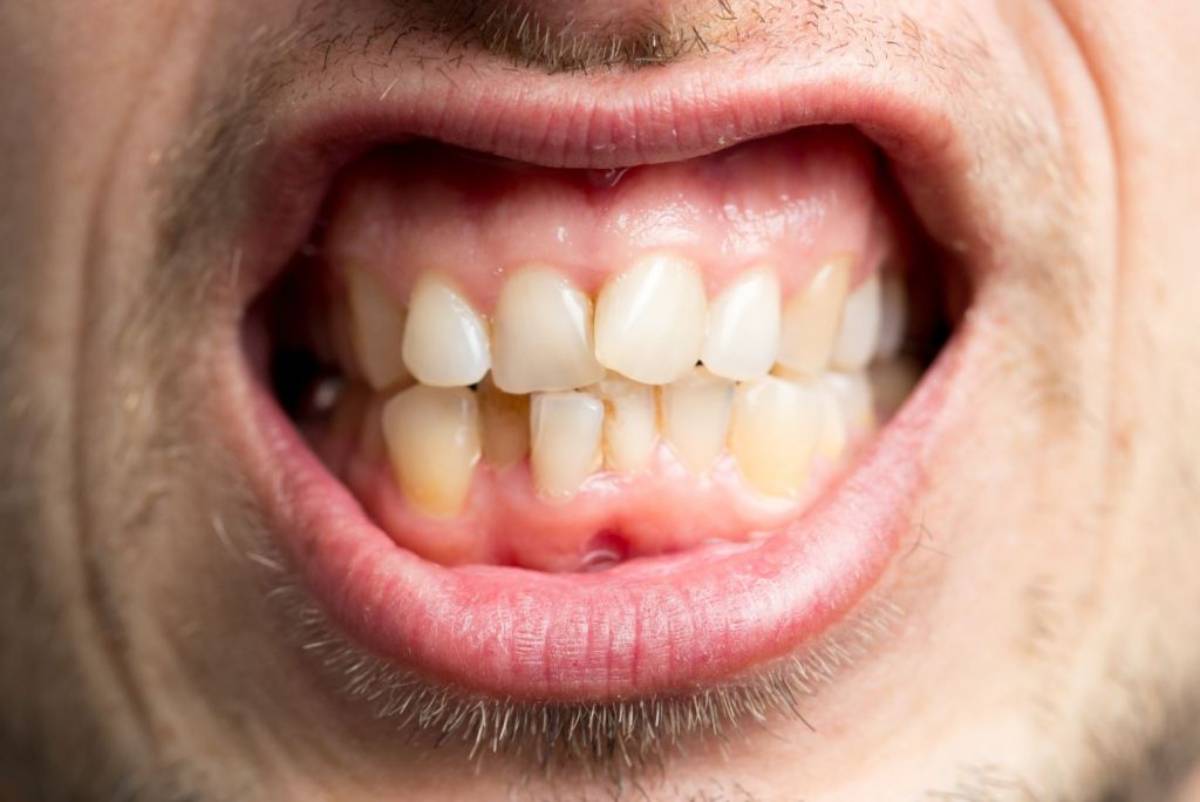 اعوجاج الاسنان - اعراض اعوجاج الاسنان