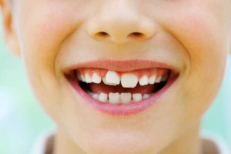 اعوجاج الاسنان - اعوجاج الاسنان عند الاطفال