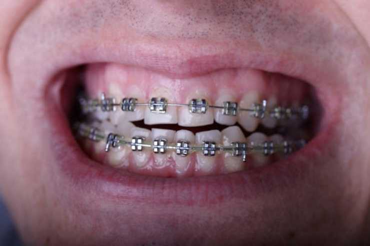 اعوجاج الاسنان - التقويم المعدني