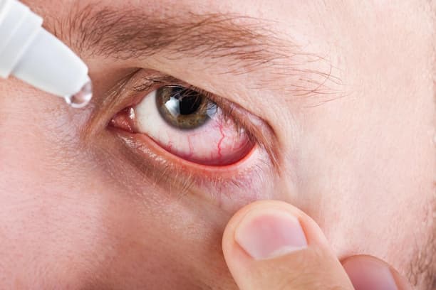 sécheresse oculaire