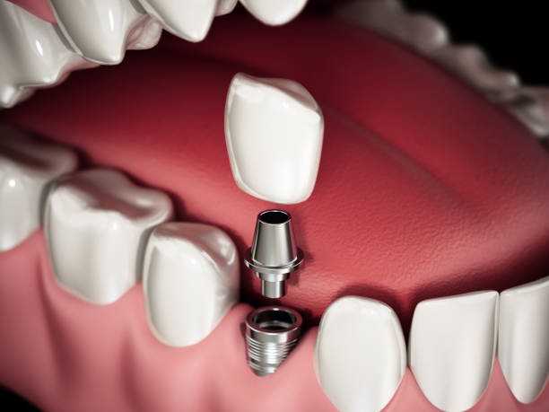 التيتانيوم في طب الاسنان