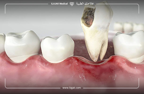 علاج خراج الاسنان - مدة شفاء خراج الأسنان