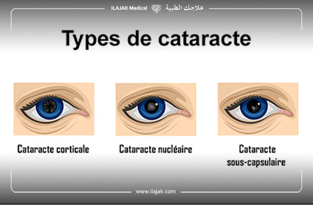 cataracte oeil - cataracte secondaire