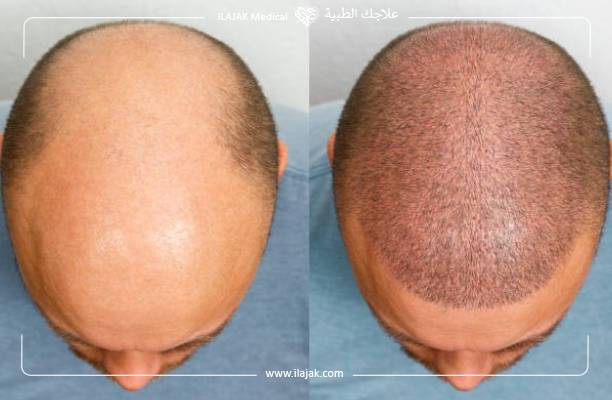 زراعة الشعر قبل وبعد,