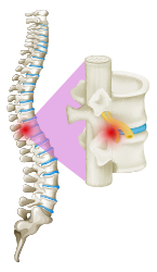 Scoliosis Surgery