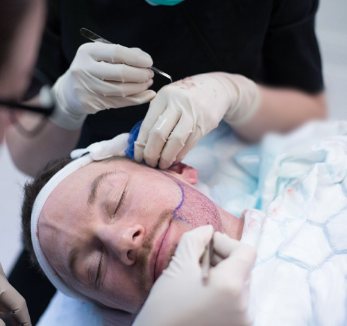 زراعة شعر اللحية والشوارب في تركيا 2021 تقنية زراعة شعر الذقن والشارب في تركيا