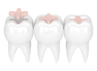 Dental Fillings