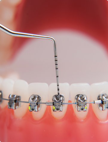 Orthodontic Treatment