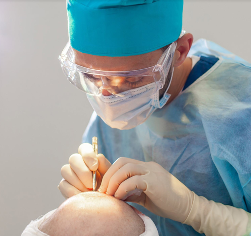 زراعة الشعر للرجال في تركيا 2021 افضل التقنيات لزراعة الشعر للرجال في تركيا