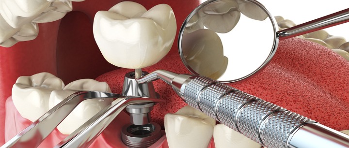 implants dentaires