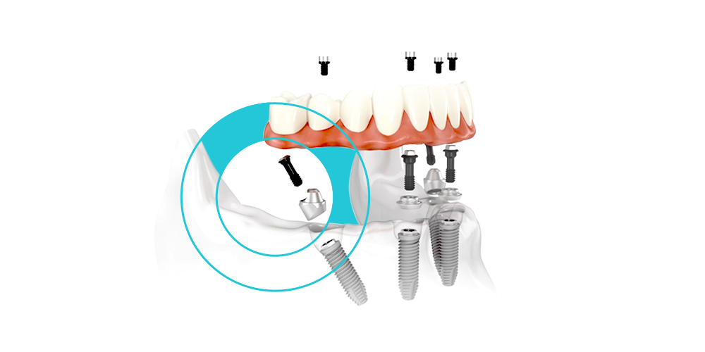 Prosthodontics